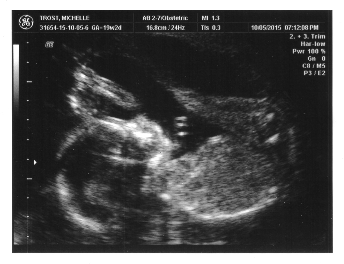 Baby-Toomey-19-Weeks